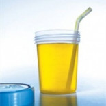 Cuando catar la orina te confirmaba una diabetes