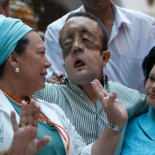 El segundo trasplantado facial de España muestra su rostro al recibir el alta médica