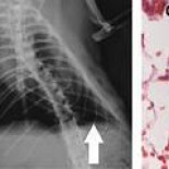 Científicos desarrollan un pulmón funcional en laboratorio