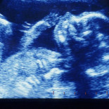 Los fetos humanos no sienten dolor antes de las 24 semanas de gestación (Eng.)