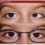 ¿Sabías por qué… a algunos niños se les pone un parche en el ojo?