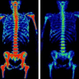 Descubren dónde se ocultan células que se escapan a la quimioterapia