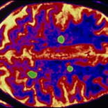 Hallan clave para revertir la esclerosis múltiple