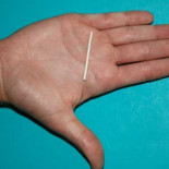 600 británicas se quedan embarazadas pese a llevar un implante anticonceptivo