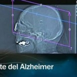 Científicos españoles desarrollan una vacuna preventiva contra el alzheimer testada en ratones