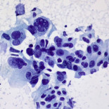 Ya han curado el cáncer… otra vez