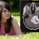 Salvó su vida porque subió a una montaña rusa que liberó la presión de un tumor en su cabeza