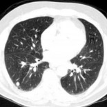 Los radiólogos tampoco vieron el gorila