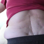 El Hospital de León niega tratamiento contra el dolor a 30 pacientes por su alto coste