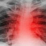 Descubierta una proteína para regenerar el corazón tras un infarto