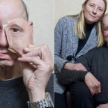 Una impresora 3D le devuelve a un hombre su rostro y calidad de vida