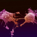 Investigadores españoles desarrollan terapia experimental que reduce en un 90 % la metástasis de melanoma en el pulmón