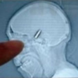 Un portero aficionado bosnio juega un partido entero con una bala en el cráneo