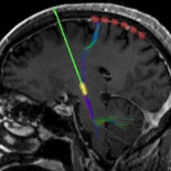 Pulsas un botón y adiós al Parkinson, pero ¿cómo funciona?