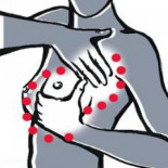 El mayor avance en cáncer de mama en los últimos 15 años tendrá copago en España