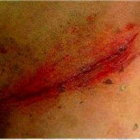 Descubren varias trampas mortales de acero en montes de Oia y Baiona