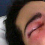 Iñaki, herido en el ojo por un pelotazo el 22-M: "Cuando aprietan el gatillo pueden destrozar una vida"