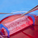 Las primeras vaginas artificiales se implantan en cuatro adolescentes