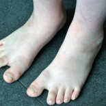 Un feto con síndrome de Down y su gemelo sano desvelan la clave genética del trastorno