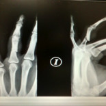 Así quedó la mano de un fotoperiodista tras una carga de los Mossos