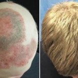 Científicos de Yale consiguen regenerar el pelo en un hombre calvo utilizando un fármaco para la artritis [ENG]