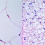 Descubren la causa detrás de la muerte de un tercio de los pacientes de cáncer