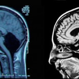 Un caso extremadamente raro de una mujer sin cerebelo desconcierta a los médicos [ENG]