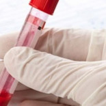 Médicos franceses logran detectar el cáncer de pulmón mediante un análisis de sangre