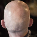 Consiguen regenerar pelo modificando células del sistema inmune