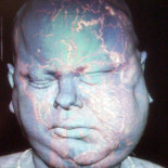 El hospital Vall d'Hebron realiza con éxito su segundo trasplante de cara