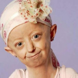 Murió Hayley Okines, la niña que se hizo anciana antes de tiempo