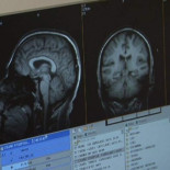 España realiza con éxito la primera operación de cerebro sin abrir el cráneo