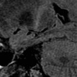 Descubren que la ELA podría estar provocada por hongos