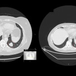 Una combinación de drogas presenta resultados espectaculares en el tratamiento del cáncer (ENG)