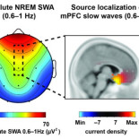 La falta de sueño se relaciona con proteína implicada en la enfermedad de Alzheimer