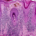 Universidad de Florida descubre cura para Lupus