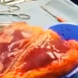 El corazón de un drogadicto late durante 25 minutos por fuera del cuerpo