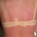 Diferencias entre las quemaduras de primer, segundo y tercer grado [ENG] [NSFW]