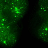 Hallan el ‘código postal’ del cáncer que decide el destino de las metástasis