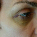 Atacan brutalmente a una voluntaria que alimentaba y esterilizaba gatos callejeros en Alpedrete