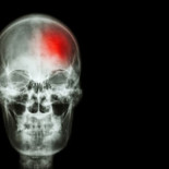 Los más jóvenes subestiman la urgencia de los síntomas del ictus