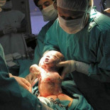 Inmunizan a bebés nacidos por cesárea frotando gasas con bacterias de la vagina materna