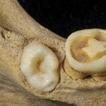 La cera de abeja era usada para cubrir cavidades dentales hace miles de años