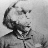 El Síndrome de Proteus, la enfermedad rara entre las raras