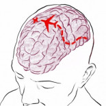 Un médico español logra reconfigurar el cerebro para tratar tumores inoperables