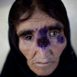 El "catastrófico" brote de leishmaniasis que se expande por Oriente Medio