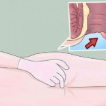 Cáncer de Ano. Estas son las 6 señales tempranas