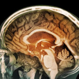 El impactante hallazgo sobre la contaminación en cerebros de personas que vivieron y murieron en Ciudad de México