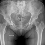 La mala calidad de las agujas para las inyecciones de insulina, denunciada judicialmente [gal]