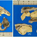 Encuentran un diminuto cerebro y un cráneo creciendo en el ovario de una adolescente